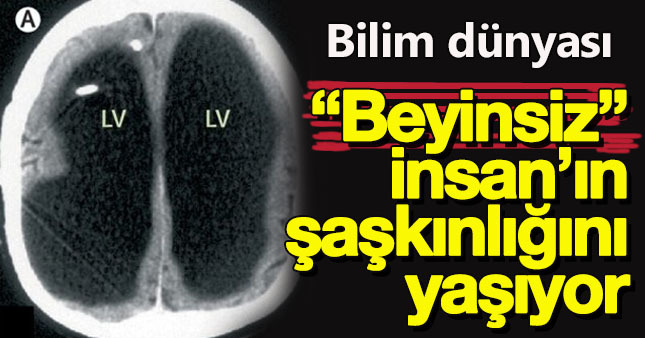 BEYİNSİZ İNSAN BULUNDU,ÜSTELİK MEMUR